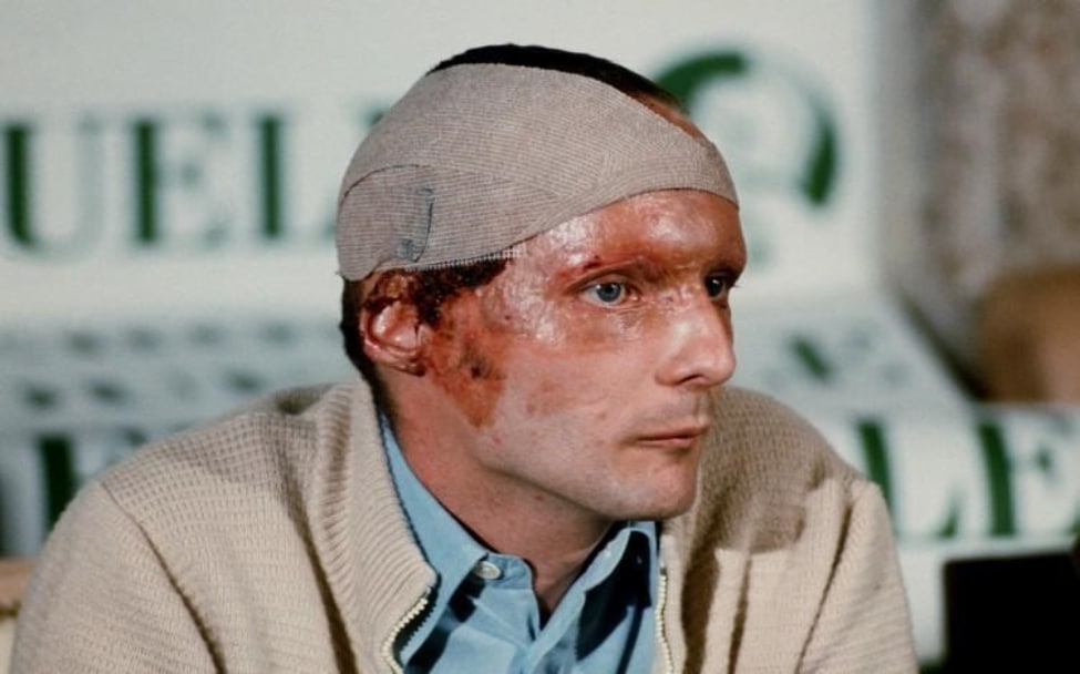 Niki Lauda at the Monza Press Conference with the fresh burns still bandaged.