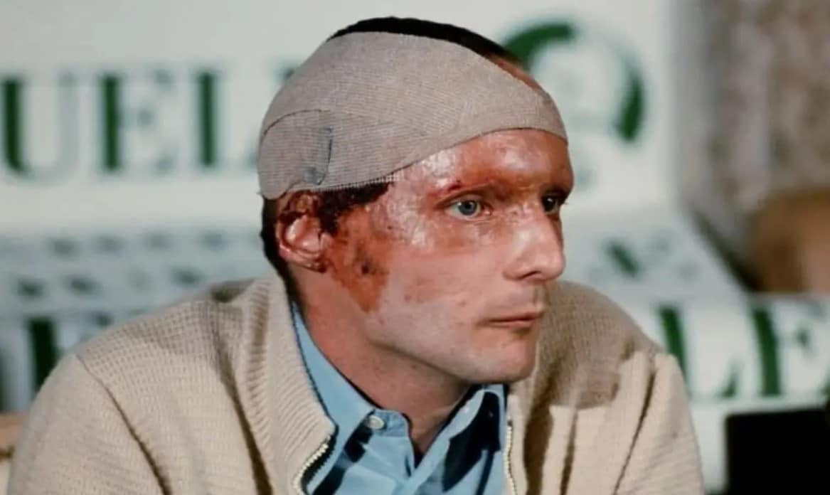 Niki Lauda is seen at the Monza Press Conference, his burns freshly bandaged. He endured extensive scarring from the burns, which led to the loss of most of his right ear, hair on the right side of his head, as well as his eyebrows and eyelids. Opting for reconstructive surgery only on the eyelids to restore their functionality, Lauda consistently wore a cap post-accident to conceal the scars on his head. Notably, he arranged for sponsors to utilize the cap for advertising purposes.